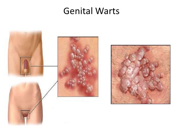 Different places to have sex Genital warts without sex